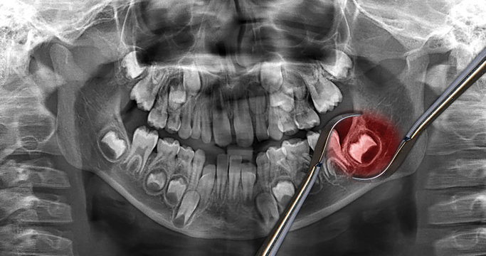 x-ray dental scan: wisdom tooth