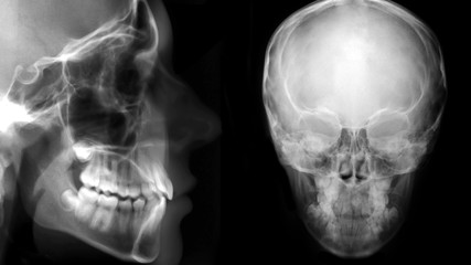 digital cephalometric, frontal and lateral x-ray