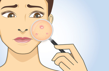 Image result for cartoon images of acne