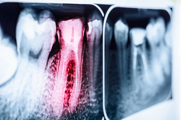 Pain Of Tooth Decay On Teeth X-Ray - 99236191