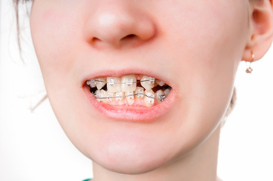 Girl with dental braces closeup