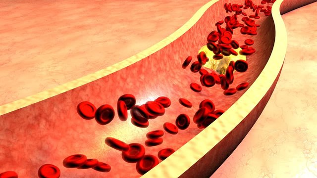 Clogged Artery with platelets and cholesterol plaque, concept for health risk for obesity or dieting and nutrition problems