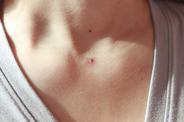 Fototapeta premium Closeup of s back and neck full of blisters,scar and rash caused