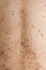 Boy with problematic skin and acne scars in the back