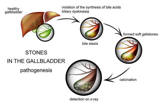 the pathogenesis of gallstones