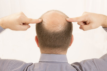 Premature baldness, man, 40s, white background