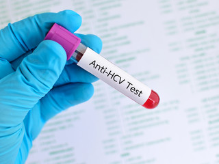 Obraz premium Anti-HCV test