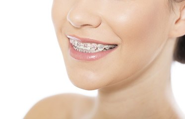 Obraz premium Beautiful young woman wearing braces