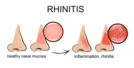 inflammation of the nasal mucosa