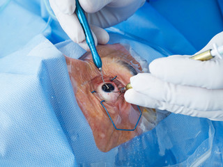 Eye surgery close-up
