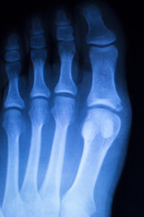 Foot and toes injury x-ray scan