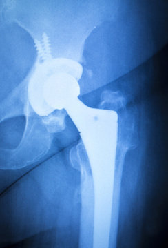 Hip Titanium Implant Replacement Xray