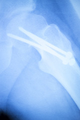 Hip titanium implant replacement xray