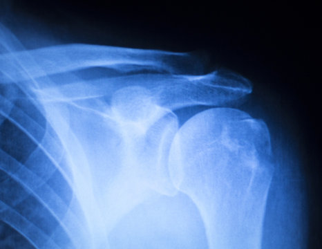 Shoulder injury orthopedics xray scan