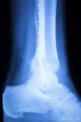 Foot ankle and shin xray scan