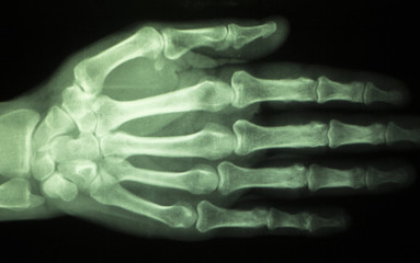 Hand finger thumb hospital xray scan