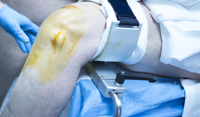 Obraz premium Knee arthroscopy orthopedic surgery operation