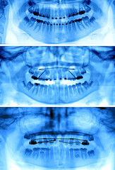 Types of fixed appliances used for orthodontic treatment © mkarco