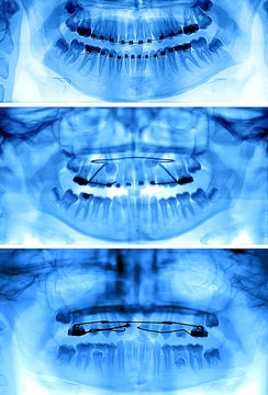 Types of fixed appliances used for orthodontic treatment