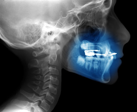 x-ray with fixed appliance used for orthodontic treatment