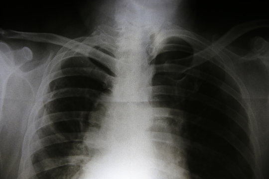 Film x-ray