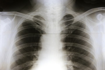 Film x-ray
