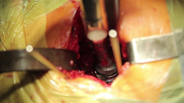 Surgical Reamer

using surgical reamer drill during the HIP replacement surgery (CU)