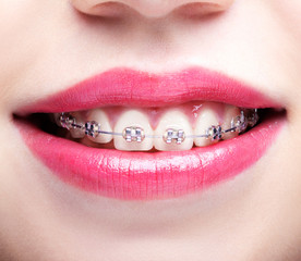 Closeup of woman open smiling mouth with  brackets