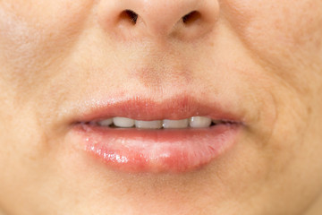 Fototapeta premium Closeup of woman swelling lips after treatment