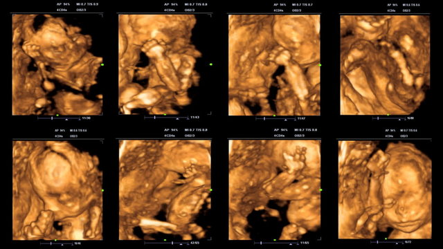Ultrasound at 22 weeks. 