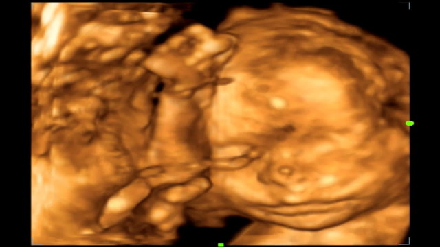 Ultrasound at 22 weeks. 