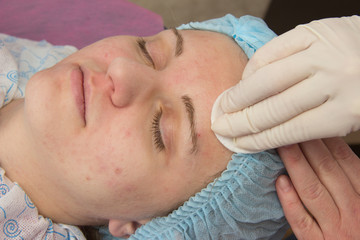 Professional acne facial cleansing in the cabin