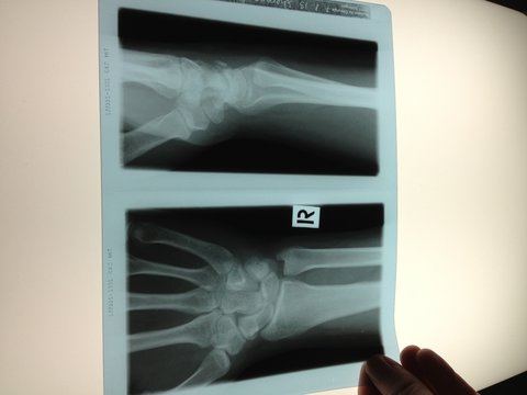 Röntgenbild Hand Manus