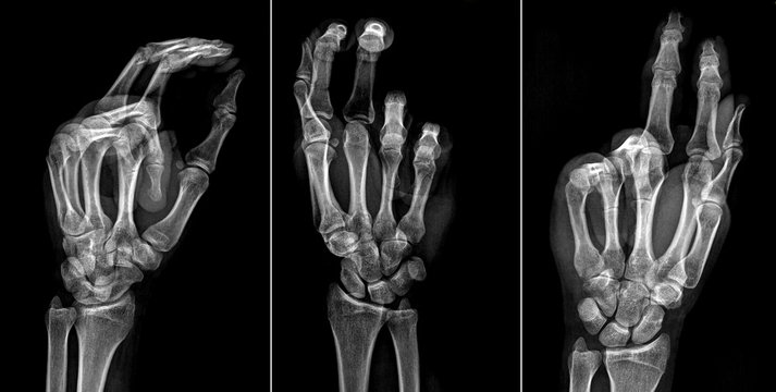 Radiografia Frattura sottocapitata V metatarso