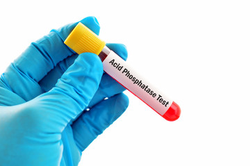 Obraz premium Blood sample for acid phosphatase test 