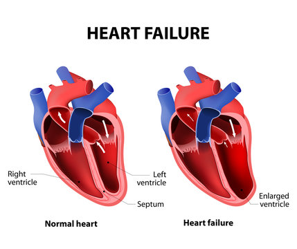 Heart failure
