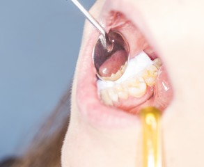 Dentist treating tooth