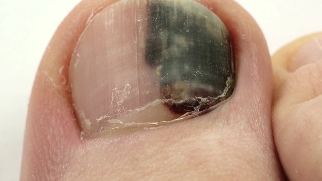 Trauma of toenail. Subungual hematoma. Bruise under the nail of big toe. Injury to the nail. Sick nail. Sickly, diseased, unhealthy nail
