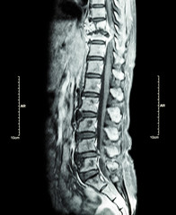 Spine metastasis ( cancer spread to thoracic spine ) ( MRI of thoracic and lumbar spine : show...