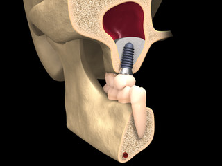 Dental anatomy - Dental implant with bone structure, teeth and mandible section © lightmachine