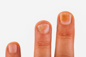 Fingernails with nail fungus