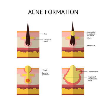 Formation of skin acne or pimple. The sebum in the clogged pore promotes the growth of a certain bacteria. Propionibacterium Acnes. This leads to the redness and inflammation associated with pimples.