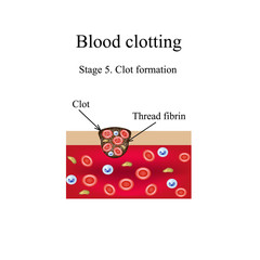 Blood clotting. 5 stage. Infographics. Vector illustration