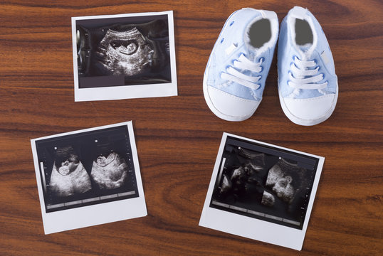 ultrasonography and sneakers