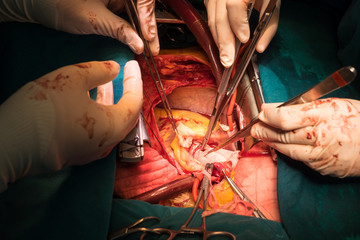 coronary re implantation