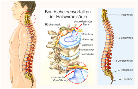 Bandscheibenvorfall am Hals