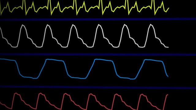 Electrocardiogram