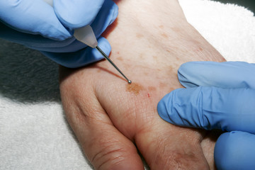 Microsurgery : Dermatologist surgeon removes skin diseases