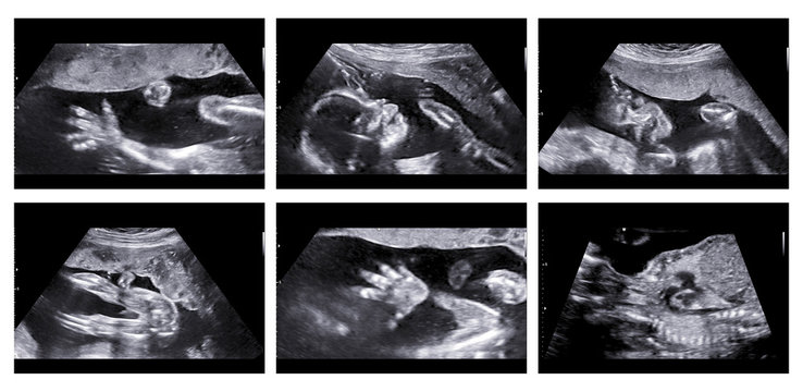 Collage of medical images of ultrasound anomaly scan