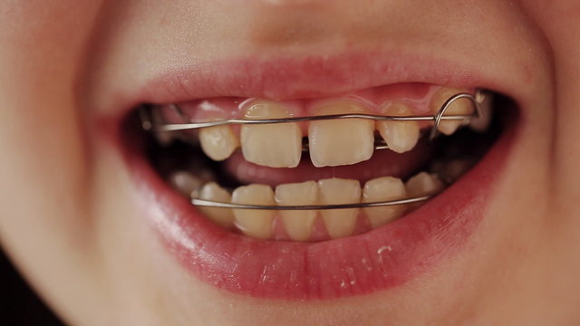 dental plate in the teeth of the child